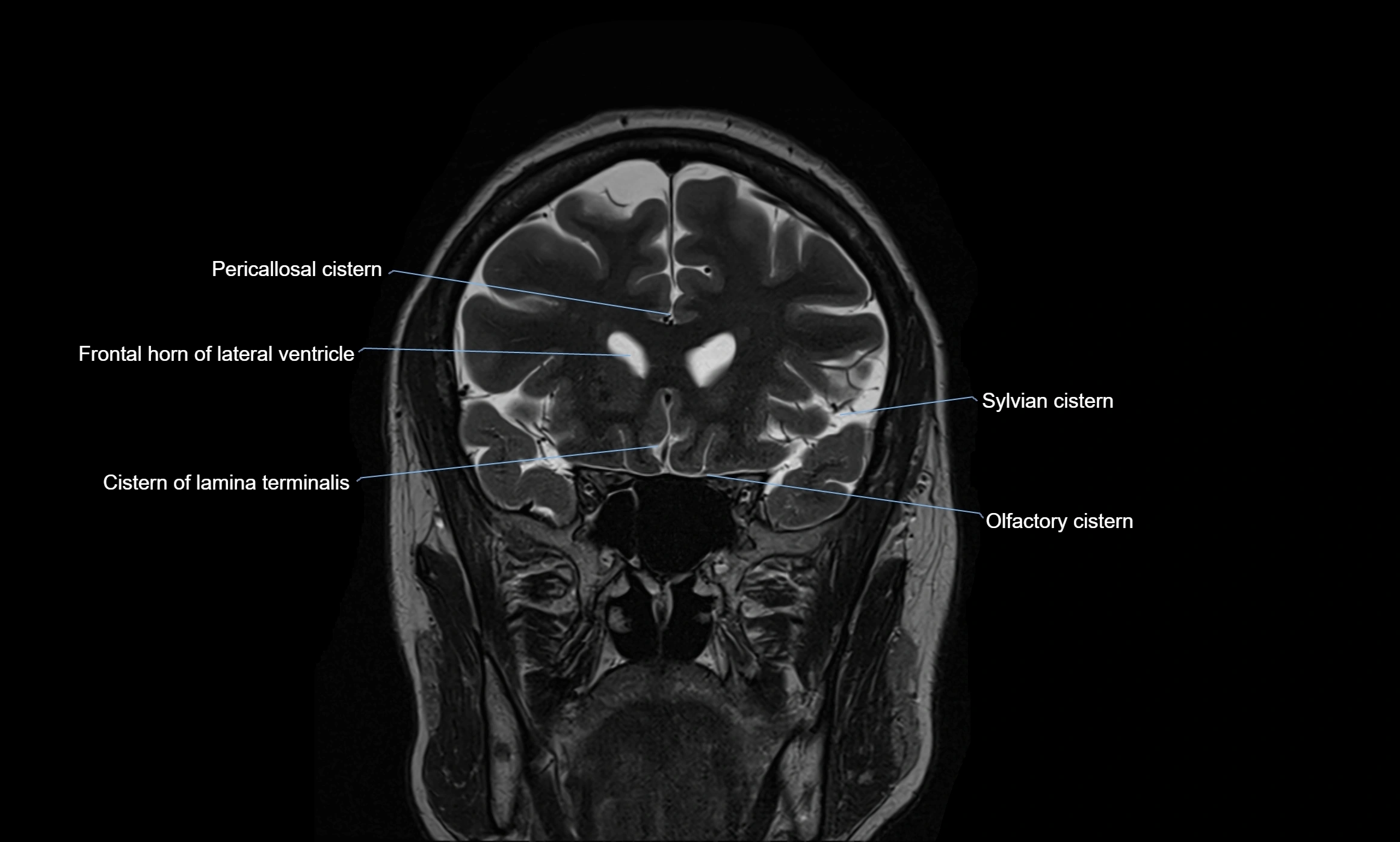 Brain cisterns  and ventricles coronal anatomy 3T MRI image-img-00001-00016.webp